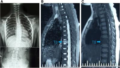 Case report: Child chronic nonbacterial osteomyelitis with rapid progressive scoliosis-an association with disease?